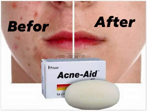 acne aid bar price in bangladesh