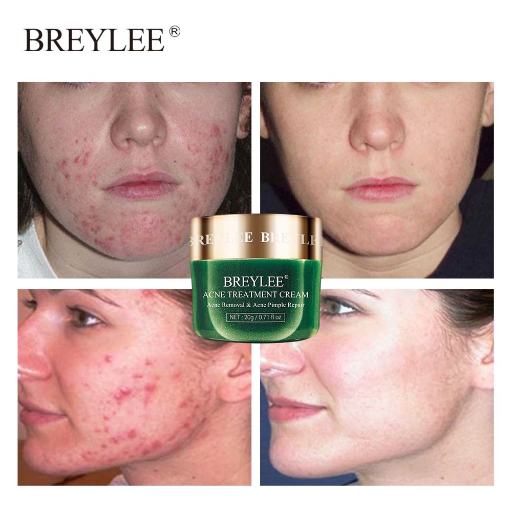 breylee acne treatment cream price in bangladesh
