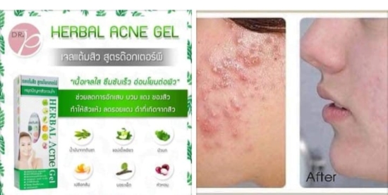 herbal acne gel skin problem