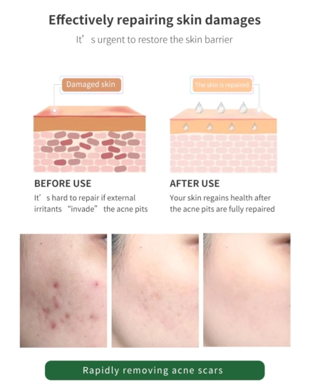 breylee acne scar removal gel