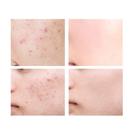 breylee acne scar removal gel